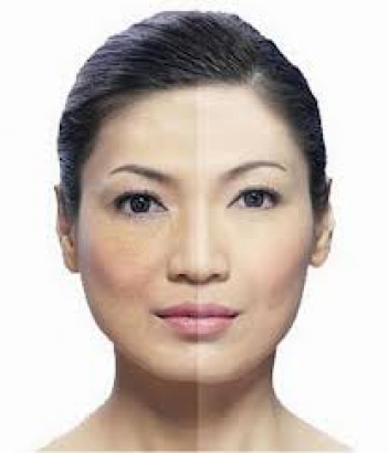 Cẩm nang điều- kem trị mụn hiệu quả